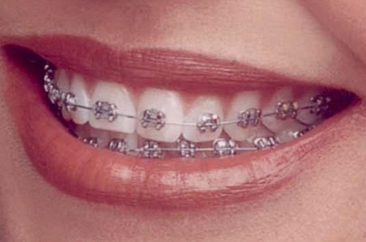metalbraces